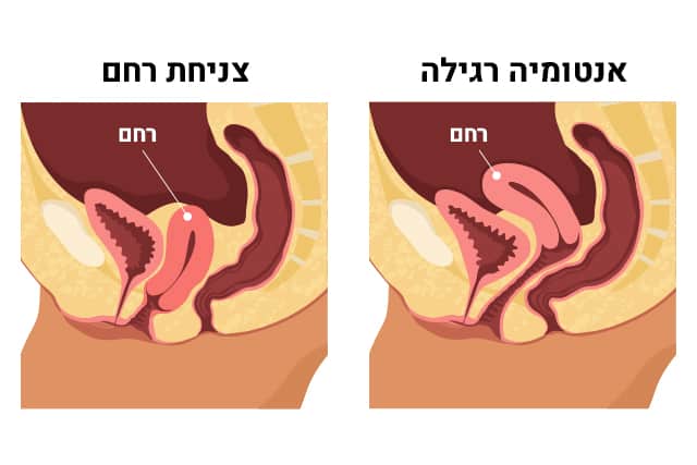 צניחת רחם תמונה